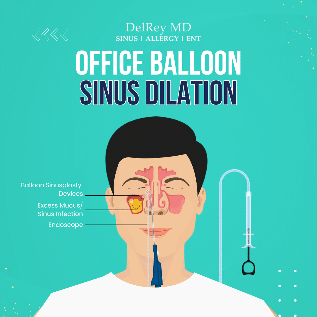 Sinusitis Treatment Marina Del Rey - Rhinosinusitis Long Beach